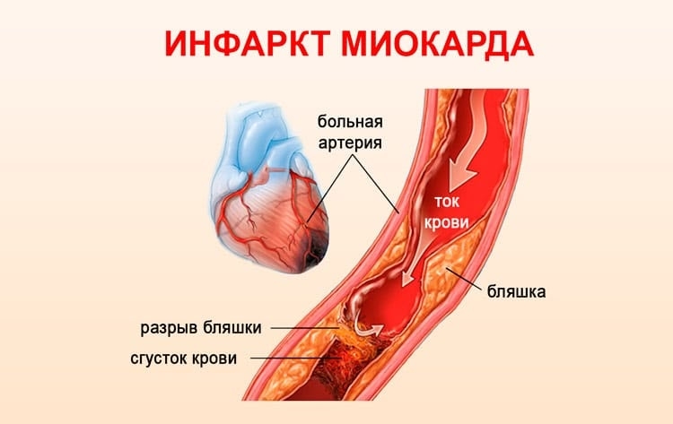 Первые признаки инфаркта миокарда: как не пропустить опасность!