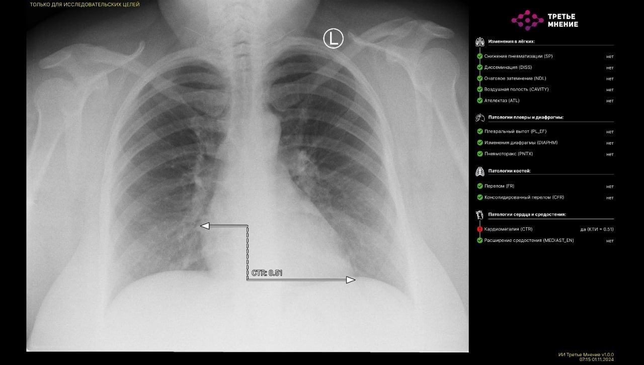 Впервые в Башкирии искусственный интеллект расшифровал рентгеновский снимок пациента.