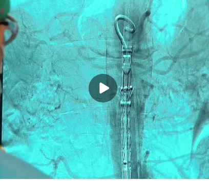 Сегодня в 21.15 на канале БСТ очередной выпуск «Медицинской энциклопедии». Он посвящен высокотехнологичной медпомощи.
